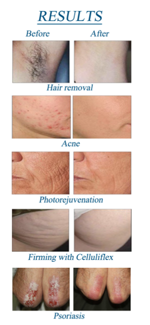 Photo-Rejuvenation OPE/IPL