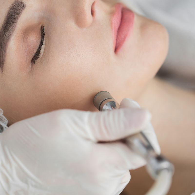 MICRODERMABRASION