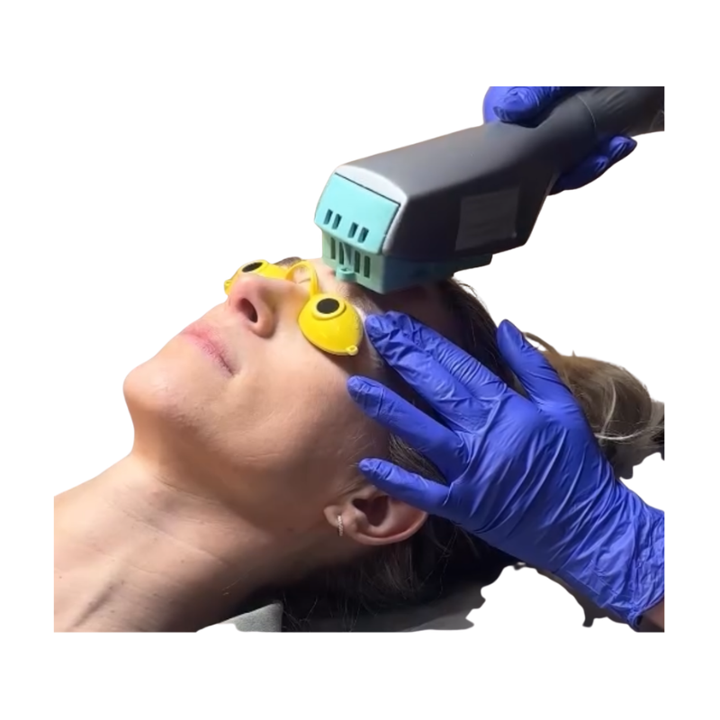 Photo-Rejuvenation OPE/IPL